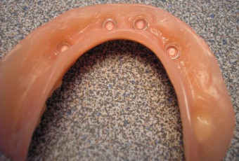 Total dental lower jaw prosthesis with retention
