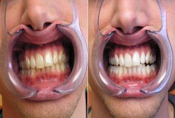 Office-based tooth whitening before and after