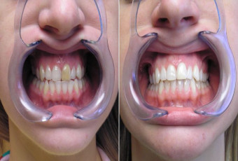 Office-based tooth whitening before and after