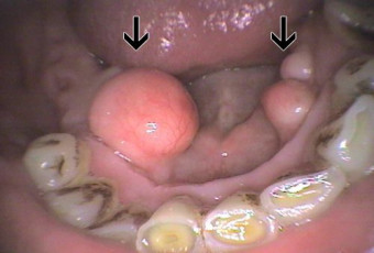 Nezhoubné nádory dutiny ústní