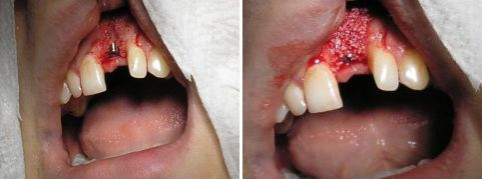 Zavedený zubní implantát - ztráta kostní tkáně po úraze