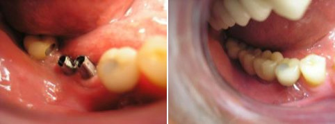  Náhrada dvou zubů v zadní partii dolní čelisti - před a po ošetření