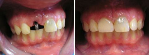 Ztráta jednoho zubu následkem úrazu a následné ošetření impl. a metalokeramickou korunkou