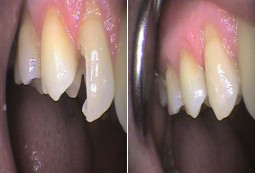 Zubní kaz - stav před a po ošetření