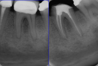 Surgery in dental root