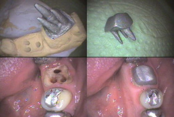 Tooth-root extension
