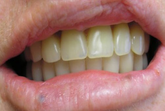 Horní celková zubní náhrada a dolní zubní náhrada