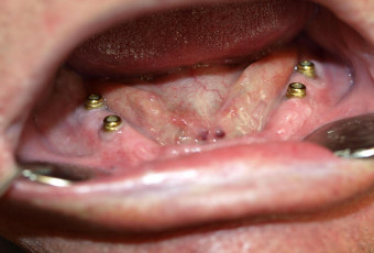Teethless lower jaw with four implants