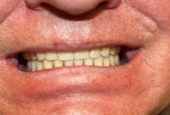 Hybridní náhrada v ústech pacienta